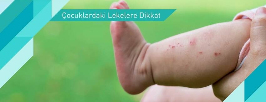 Çocuklardaki Lekelere Dikkat