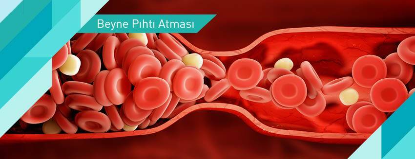 Pıhtı atması nasıl önlenir?