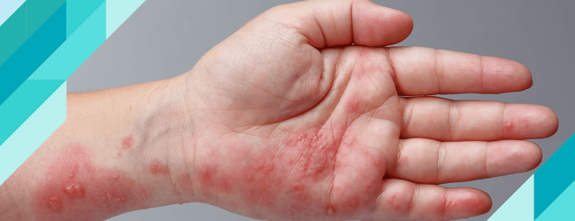 What is Shingles? What Causes Shingles?