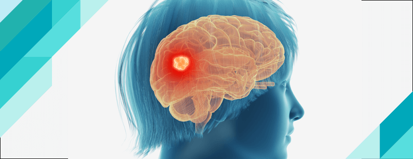 What is a Brain Tumor? What Causes a Brain Tumor?