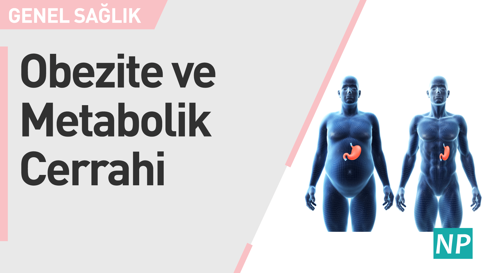 Obezite ve Metabolik Cerrahi