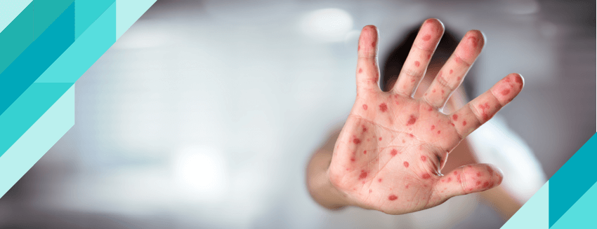 What is Hand Foot and Mouth Disease?