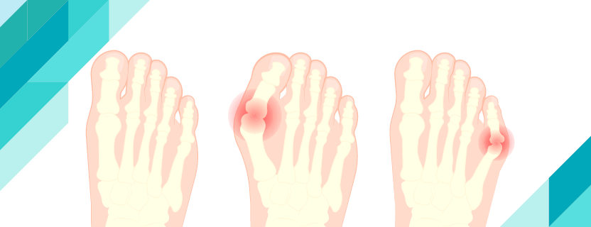 Что такое Hallux Valgus?