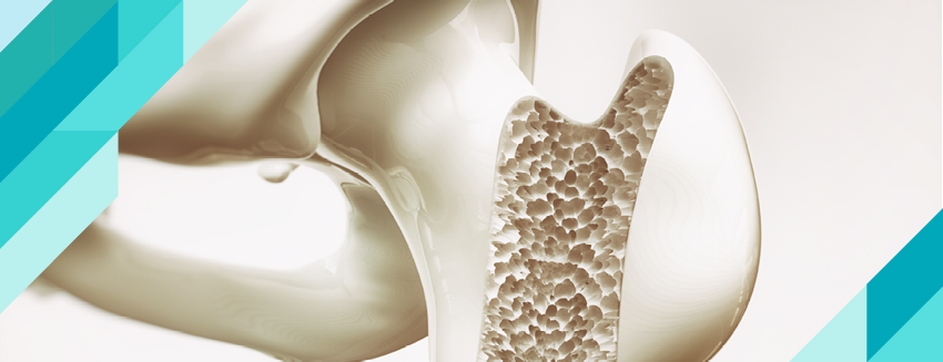 What is Osteoporosis (Bone Resorption)? Symptoms and Treatment