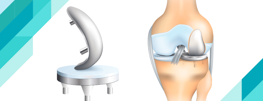 What is Partial Knee Replacement?