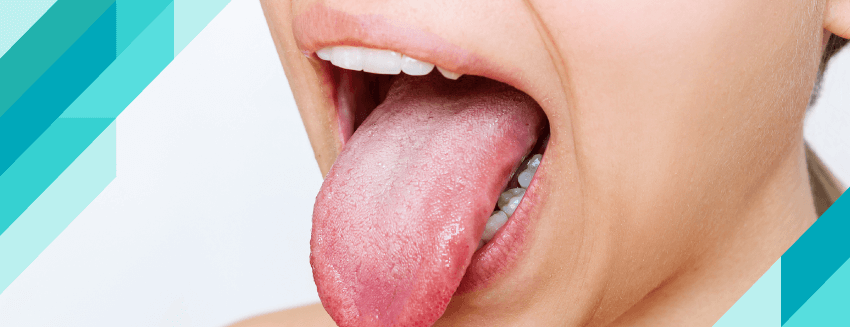 What is Thrush (Tongue Fungus)?