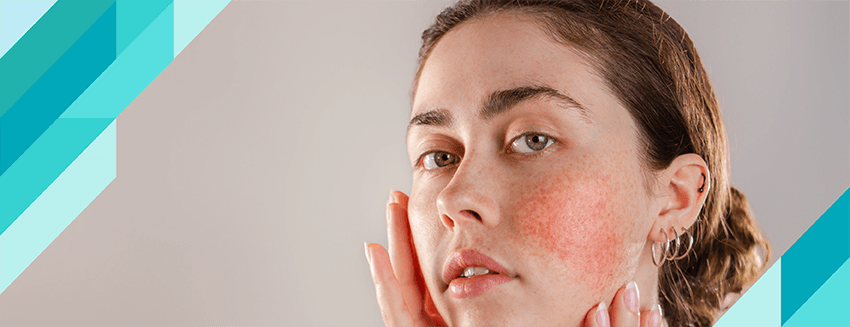 What is Rosacea (Rose Disease)?