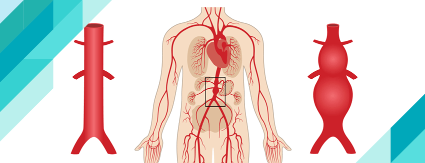 ما هو تمدد الأوعية الدموية الأبهري؟