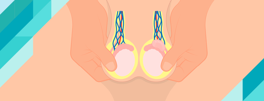 What is Varicocele?