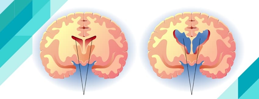 What is Huntington's Disease?