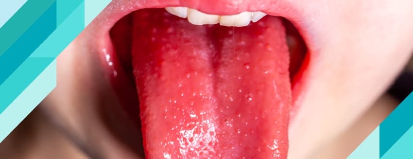 What is Scarlet Fever?