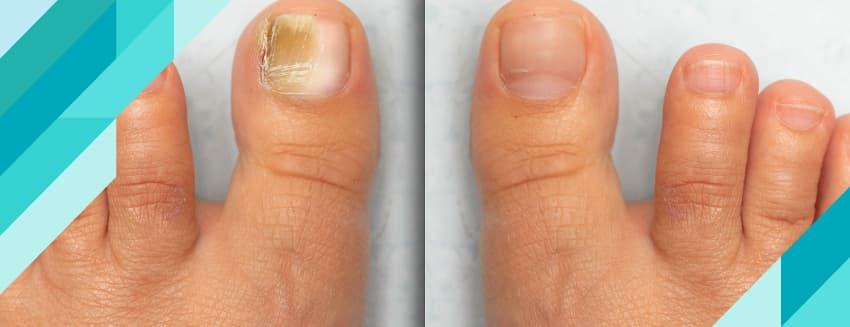 What is Nail Fungus? How Does It Go Away?