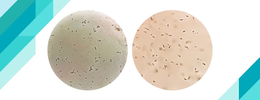 What is Azoospermia (Azoospermia)?