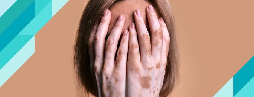 Vitiligo Nedir? Neden Olur?