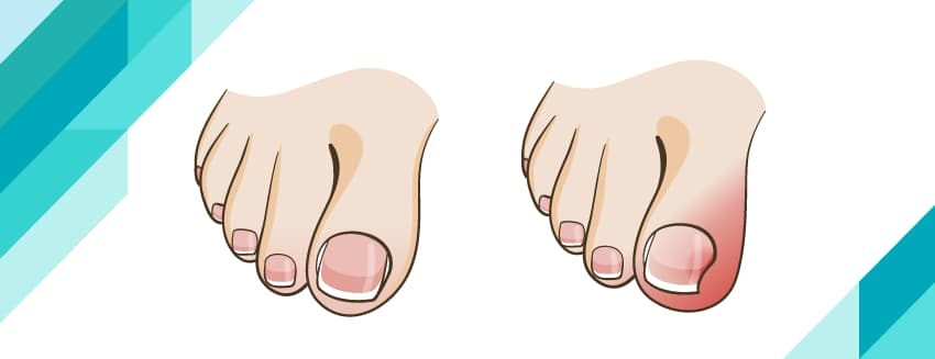 What Causes Ingrown Nail and How Does It Go Away?