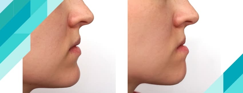 كيف تتعرف على انزلاق الفك؟