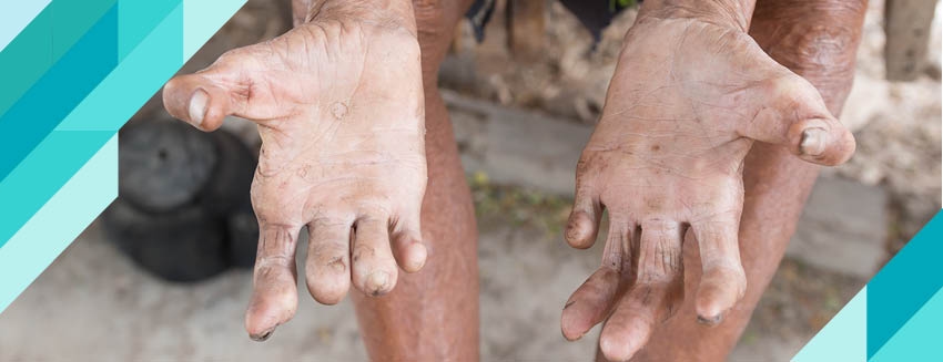 What is Leprosy?