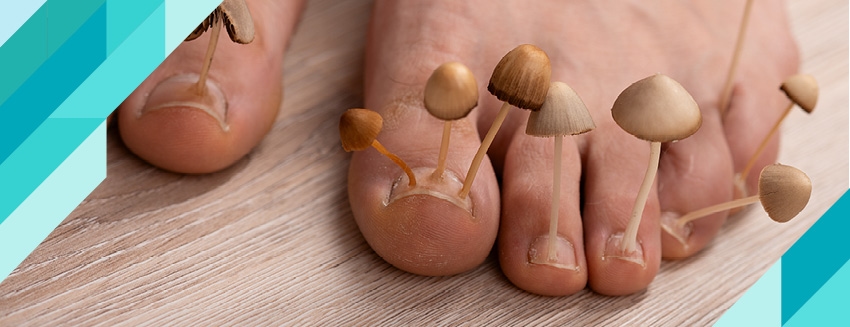 What is Foot Fungus?