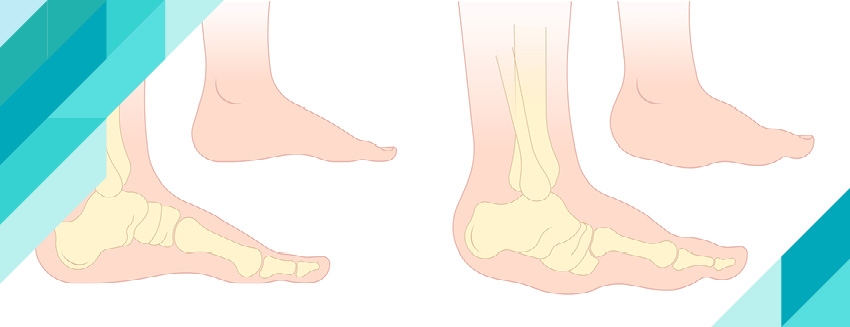 What is Charcot Marie Tooth Disease?