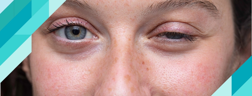 What is Myasthenia Gravis?