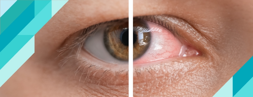 What are Eye Diseases? Symptoms and Treatment Methods