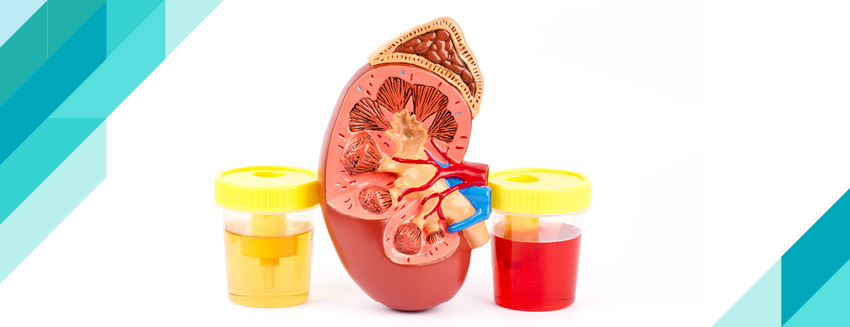 What is Hematuria?