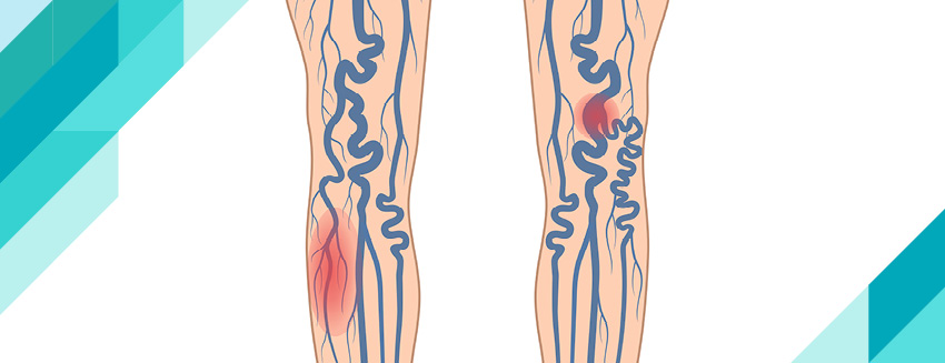 What is Thrombophlebitis?