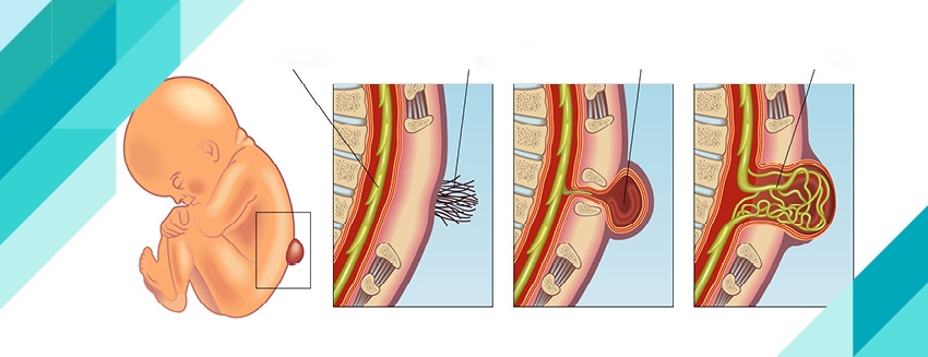 Spina Bifida