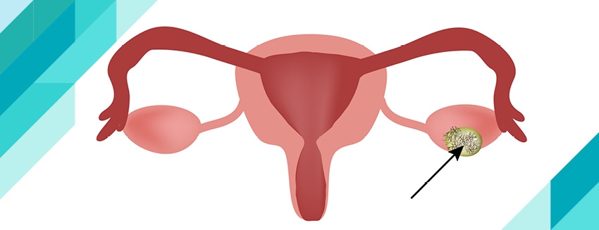 What is a Dermoid Cyst?