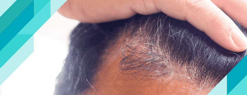 Saçkıran (Alopesi Areata) Nedir? Belirtileri ve Tedavisi