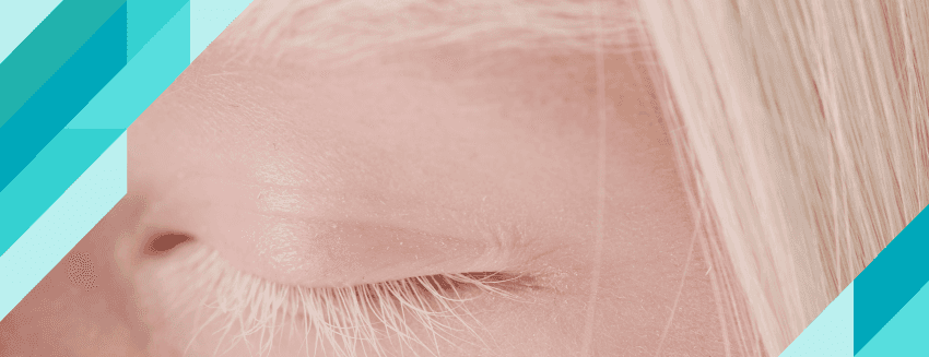 What is Albino (Albinism)? What are the Symptoms?