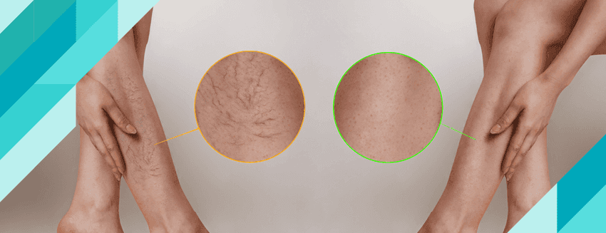 Ameliyatsız Varis Tedavisi Nedir?