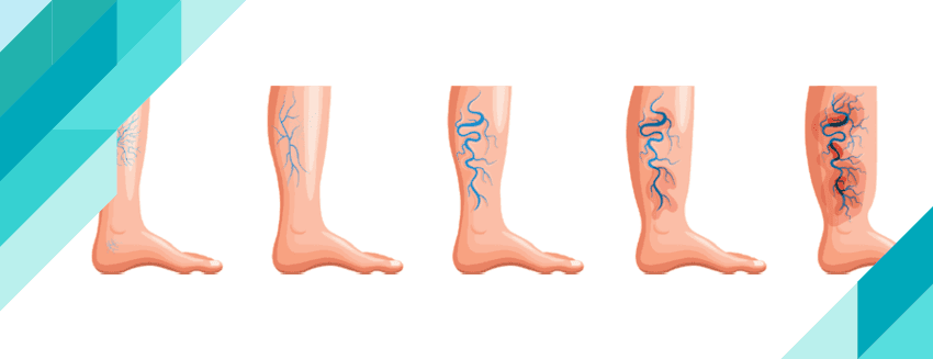 Varis Nedir? Belirti ve Tedavi Yöntemleri Nelerdir?