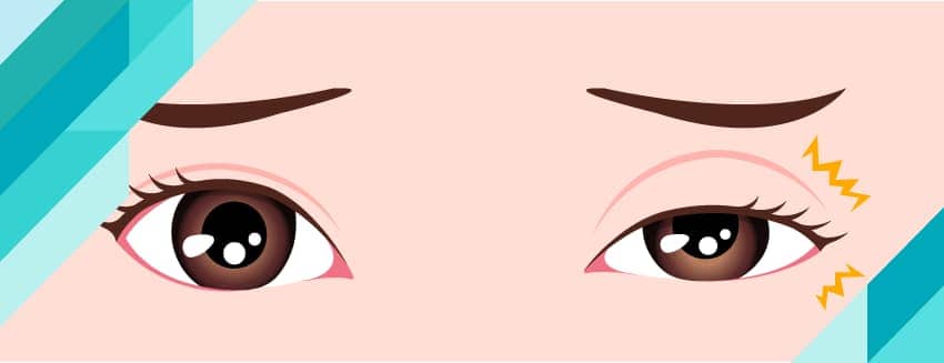 Göz Seğirmesi Nedir? Neden Olur?