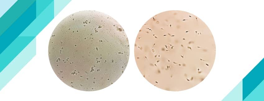 Azospermi (Azoospermia) Nedir?