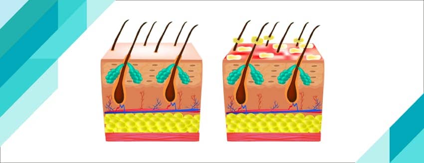 Seboreik Dermatit Nedir?