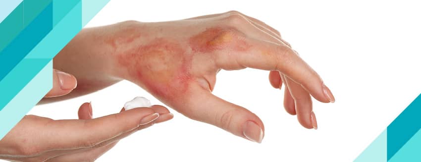 Yanık İzi Nasıl Geçer?