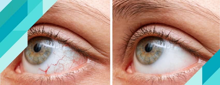 Göz Kanlanması Nedir?