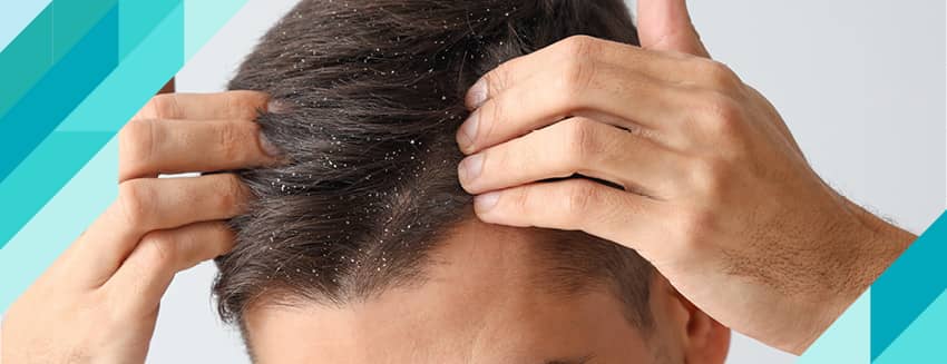 ما هي قشرة الرأس، وكيف تنتقل؟