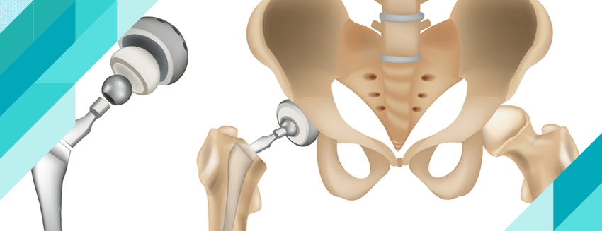 Total Kalça Protezi Ameliyatı Nedir?  