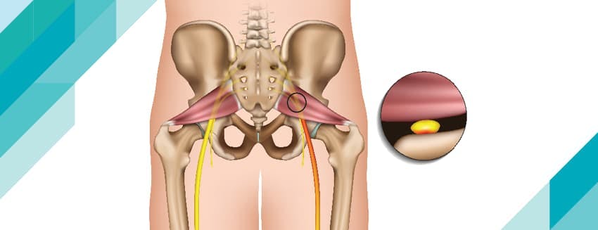 Piriformis Sendromu Nedir?  