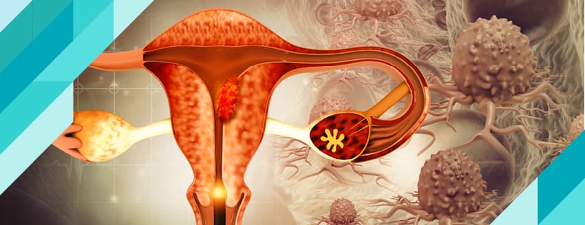 Endometriozis (Çikolata Kisti) Nedir?