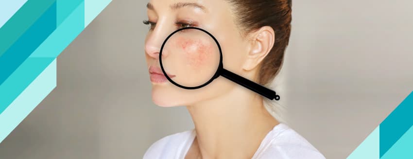 Psikodermatoloji Nedir?