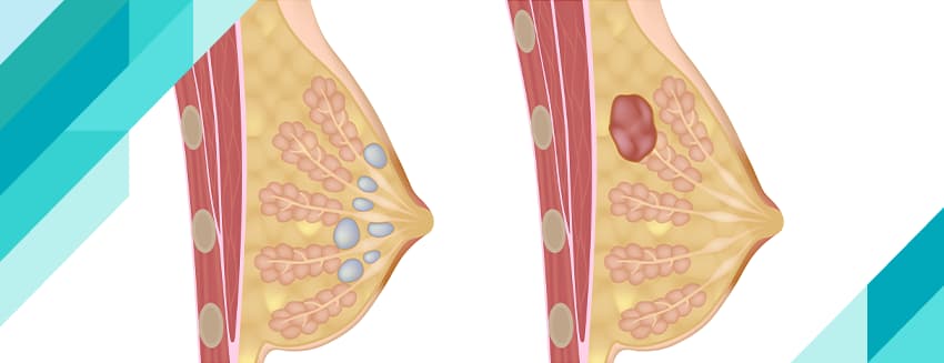 Fibroadenom Nedir?