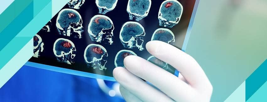İleri yaştaki sara nöbetleri, beyin hastalığının işareti olabilir