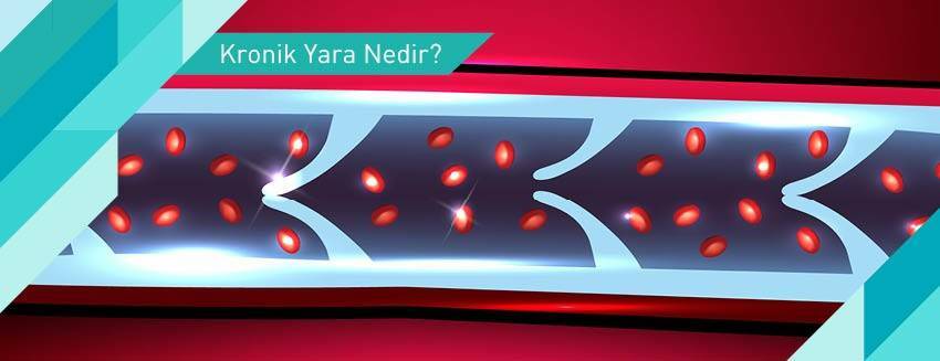 Kronik Yara Nedir?
