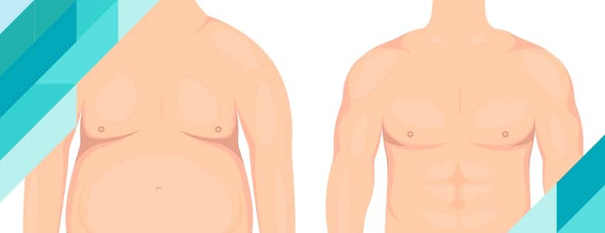 Что такое гинекомастия?