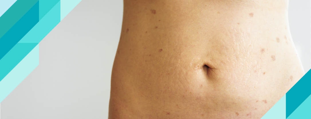 Liken Planus Nedir?